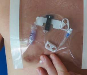 HydroSeal Wound Protector, Medium, 1 Case of 140 (General Wound Care) - Img 2